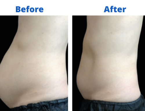 Emsculpt NEO: The Trifecta! 3 treatments in 1, Incredibly effective, Amazing value
